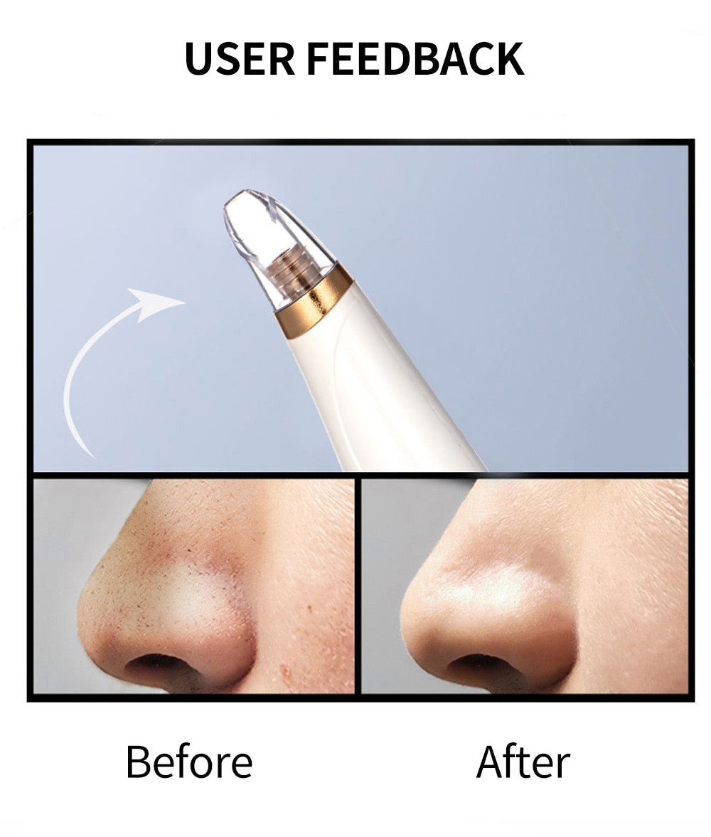 Blackhead Remover Vacuum Deep Pore Facial Cleaner Device